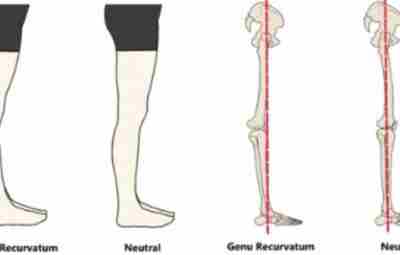 4 причины рекурвации коленного сустава 1. Укороченная икроножной мышца с повышенным тонусом в ней…