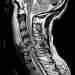 Травма спинного мозга в результате перелома позвоночника. Результат ДТП