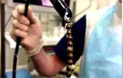 В Уфе ребенок, который проглотил 10 магнитных шариков, был спасен врачами. Врачи из БСМП…