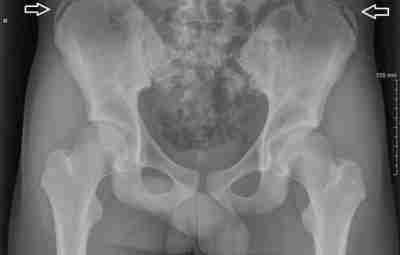 Болезнь Бьюкенена (остеохондропатия гребня подвздошной кости) – проще говоря, это асептический некроз гребня подвздошной…