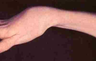 Контрактура Фолькмана — причины, диагностика, лечение Контрактурой Фолькмана называется ишемическое сморщивание мышц руки. Нередко…