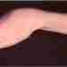 Контрактура Фолькмана — причины, диагностика, лечение Контрактурой Фолькмана называется ишемическое сморщивание мышц руки. Нередко…