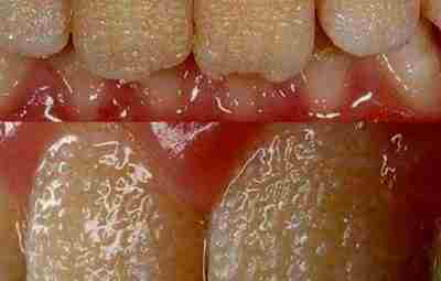 Пример несовершенного амелогенеза — нарушение эмалеобразования, которое проявляется нарушением структуры и минерализации зубов, изменении…