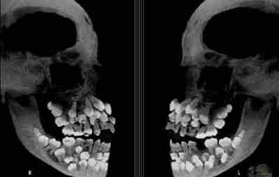 Полиодонтия — это название, данное аномалии числа зубов, которую возможно обнаружить на рентгеновском снимке