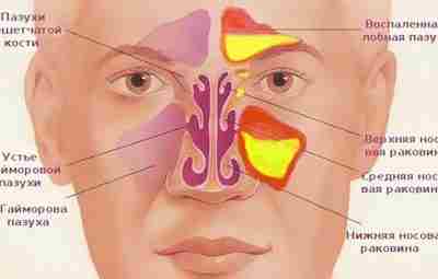 Как очистить гайморовые и лобные пазухи от гноя и слизи? Хронический гайморит и синусит…
