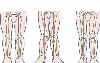 Одной из частых проблем, с которой родители обращаются к ортопеду, является Х-образное искривление ног…