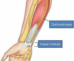 Канал Гийона (или Гюйона) — одно из возможных мест компрессии локтевого нерва. Этот канал…