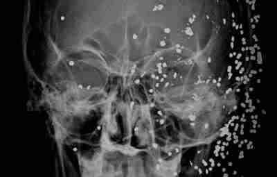 Рентгеновский снимок головного мозга человека, который был поражен в лицо дробью: