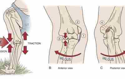 Повреждения связок локтевого сустава Клинически значимая анатомия Локтевой сустав стабилизируется тремя связками: Локтевая коллатеральная…