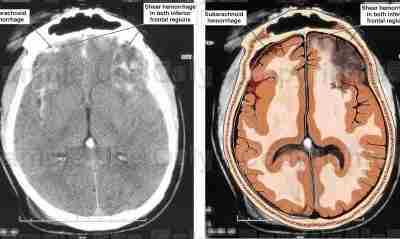 ОСОБЕННОСТИ КОМПЛЕКСНОЙ РЕАБИЛИТАЦИИ БОЛЬНЫХ С ЧЕРЕПНО-МОЗГОВОЙ ТРАВМОЙ. Травмы головного мозга составляют до 30-40% общего…