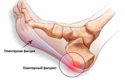Плантарный фасциит — новое исследование Майкла Рэтлиффа Плантарный фасциит может быть неприятен в лечении,…