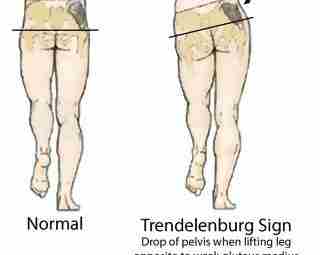 Тест Тренделенбурга:пациент стоит, врач просит его встать на одну ногу. При слабости ягодичных мышц,…