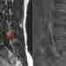 КОСТОЧКИ ОППЕНГЕЙМЕРА (ОППЕНХЕЙМЕРА) Оппенгеймеровы косточки (Oppenheimer ossicle) являются добавочными косточками, связанными с дугоотросчатыми суставами…