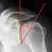 Критический угол плеча (Critical shoulder angle-CSA ) Является расчетным рентгенологическим признаком, который, по результатам…