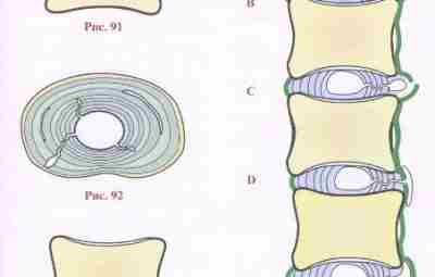 РАЗЛИЧНЫЕ ТИПЫ ГРЫЖИ МЕЖПОЗВОНКОВОГО ДИСКА При осевой компрессии вещество пульпозного ядра может смещаться в…