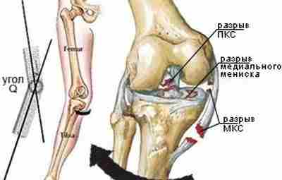 Боль в колене это результат несбалансированной работы мышц. Перегрузка связок, а вследствие травма сустава,…