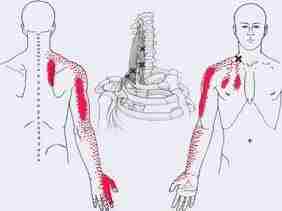 Синдром лестничной мышцы. Лечение через триггерные точки https://m.vk.com/@med_sport-sindrom-lestnichnoi-myshcy-lechenie-cherez-triggernye-tochki Article