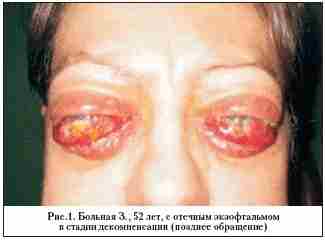 Как можно потерять зрение, лечась у гомеопата по поводу диффузного токсического зоба. Про эндокринную…