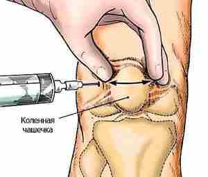 Внутрисуставные инъекции кортикостероидов при остеоартрите (остеоартрозе) коленного сустава: что нужно…