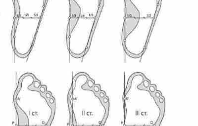 ИЗМЕРЕНИЯ СТОПЫ ПРИ ПОПЕРЕЧНОМ ПЛОСКОСТОПИИ В ДОМАШНИХ УСЛОВИЯХ. Все измерения стоп должны проводится под…