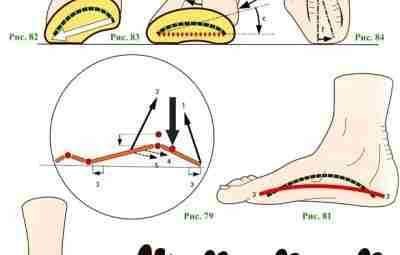 ПЛОСКАЯ СТОПА. Сильное опущение подошвенного свода обусловлено слабостью его природных…