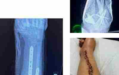Перелом руки практически в дребезги, но профессиональная работа хирургов дала надежду на полное восстановление