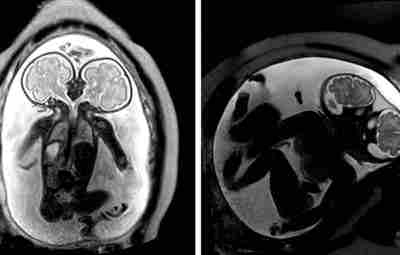 Редкий случай сиамских близнецов на МРТ-снимках беременной женщины на 23 неделе. Две головы при…
