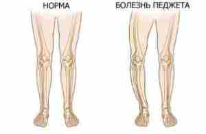 Болезнь Педжета (костей) Описание Болезнь Педжета (деформирующая остеодистрофия) — хроническое заболевание, которое характеризуется патологическим…