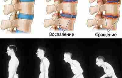 Анкилозирующий спондилоартрит (Ankylosing Spondylitis, болезнь Штрюмпелля-Бехтерева-Мари), или болезнь Бехтерева — хроническое системное заболевание суставов…