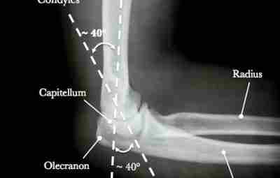 Угол наклона мыщелков плеча (shaft condylar angle/Humerotrochlear Angle) Угол наклона мыщелков или плече-трохлеарный угол…