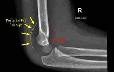 Признак паруса Sail sign (elbow) Знак «паруса» на боковой рентгенограмме локтевого сустава, также известный…