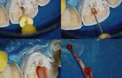 Удаление нерва из зуба
