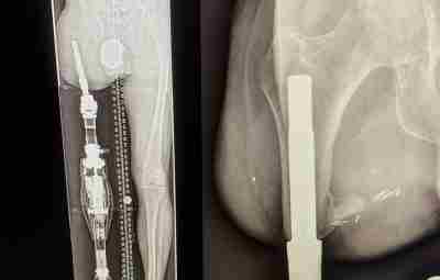 Так выглядит протез выглядит на рентгеновском снимке: