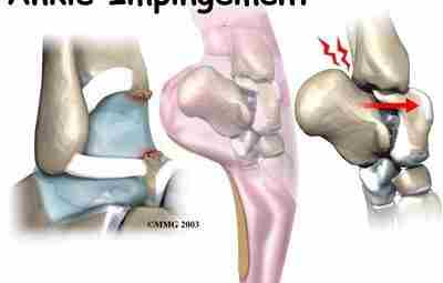 Импиджмент-синдром голеностопного сустава Импиджмент-синдром голеностопного сустава – это патологическое состояние, возникающее вследствие конфликта при…