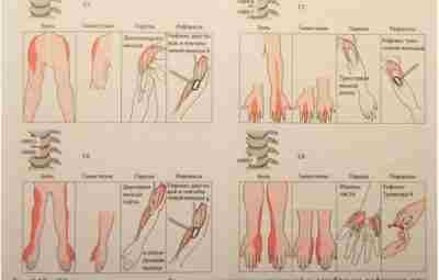 НЕВРОЛОГИЧЕСКАЯ СИМПТОМАТИКА ПРИ КОМПРЕССИОННОМ СИНДРОМЕ НА ШЕЙНОМ УРОВНЕ