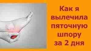 Как вылечить шпору в домашних условиях: 1. Соль + сода. Для приготовления взять максимально…