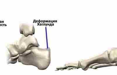 ОСТЕОФИТ ПЯТОЧНОЙ КОСТИ (Деформация Хаглунда) Остеофит (костный нарост), который появляется на задней части пяточной…