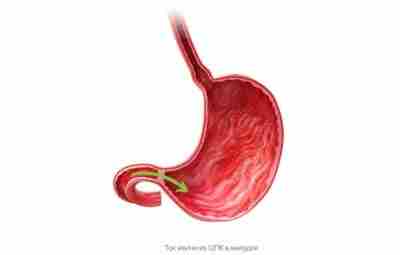 Желчь в желудке (дуоденогастральный рефлюкс) Во многих частных клиниках (как и в государственных поликлиниках)…