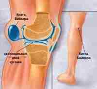КИСТА БЕЙКЕРА Киста Бейкера — это грыжа в области колена, она так же известна…