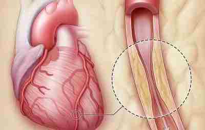 План обследования при подозрении на ишемическую болезнь сердца Для подробной оценки состояния здоровья при…