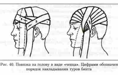 Повязка на голову в виде «чепца» Показана при ранениях головы для остановки кровотечения и…