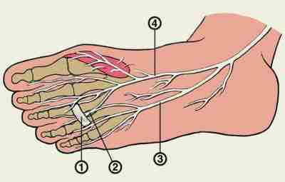 Невропатия 4-го подошвенного пальцевого нерва (мортоновская метатарзальная невралгия) развивается вследствие сдавления этого нерва под…