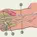 Невропатия 4-го подошвенного пальцевого нерва (мортоновская метатарзальная невралгия) развивается вследствие сдавления этого нерва под…