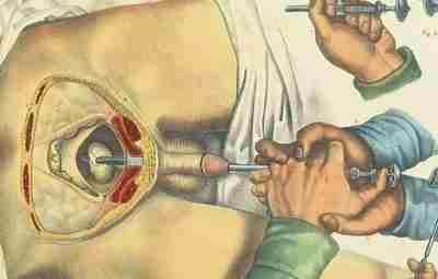 Медицина прошлого На этом наглядном рисунке — девайс прямиком из 19 века, эдакая «дробилка»,…