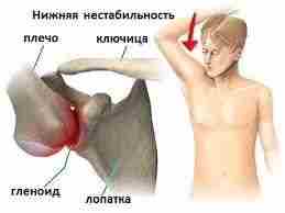 НЕСТАБИЛЬНОСТЬ ПЛЕЧЕВОГО СУСТАВА. В плечевом суставе действует две группы стабилизаторов: 1. пассивный: головка плечевой…