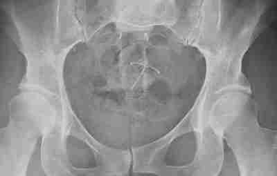 На этом рентгеновском снимке вы можете увидеть внутриматочную спираль и пирсинг