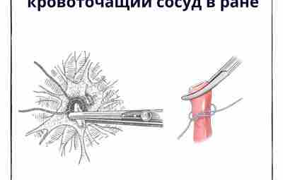 Наложение зажима на кровоточащий сосуд в ране При некоторых видах ранений остановка кровотечения наложением…