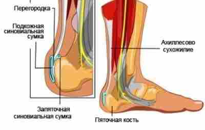 КАК ЛЕЧИТЬ ВОСПАЛЕНИЕ АХИЛЛОВА СУХОЖИЛИЯ Ахиллово сухожилие имеет второе название пяточного сухожилия, является самым…