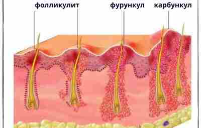 ▪Фурункул Фурункул – это острое гнойно-некротическое воспаление волосяного фолликула и окружающих его тканей. ●…