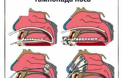 🟩Тампонада носа — передняя и задняя Тампонада носа используется при носовых кровотечениях различной этиологии….